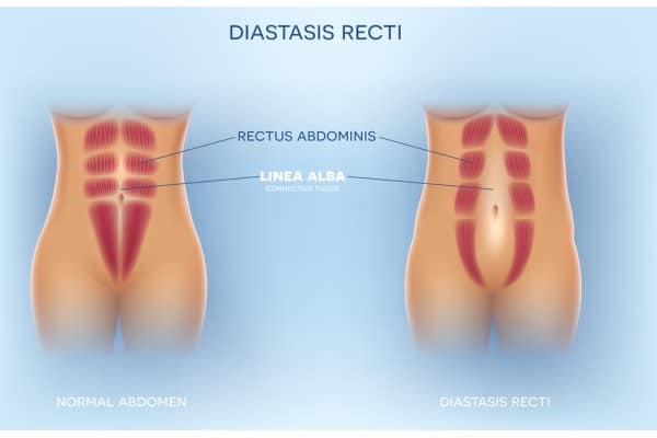 What Non-Surgical Options Are Available for Diastasis Recti Craiglockhart?