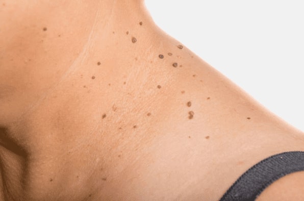 Are you looking for easy skin tag removal Craiglockhart - then contact Spire today!