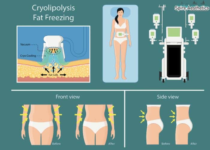 Image of diet and fat freezing combined for best results for Spire Aesthetics Craiglockhart