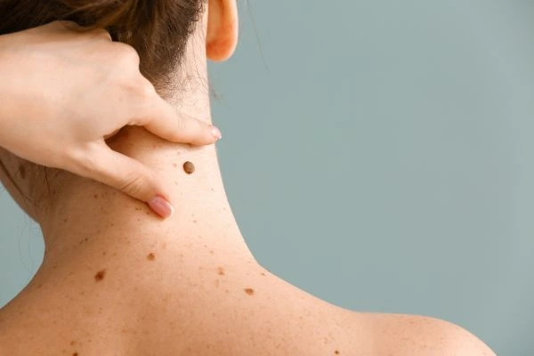 skin blemish removal Craiglockhart treatment
