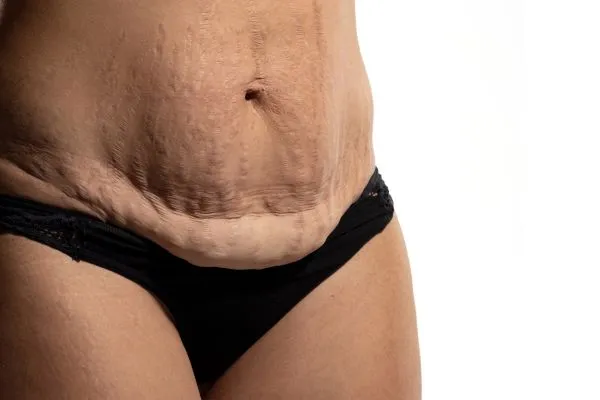Image of womans stomach after weight loss injections Craiglockhart showing saggy skin